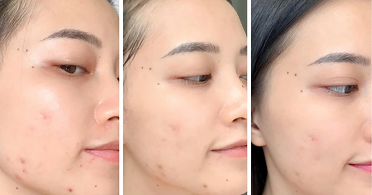 Chấm dứt nỗi lo da bị thâm mụn trong 4 tuần, da trắng sáng đều màu