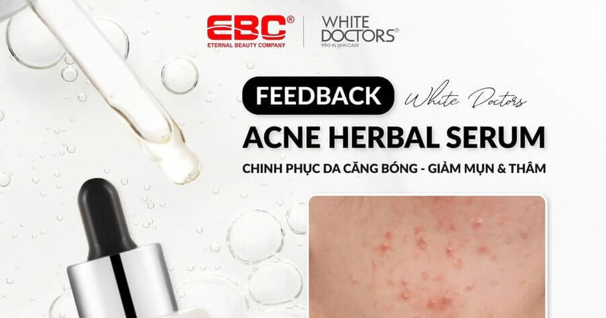 Review serum White Doctors Acne Herbal Serum có thật sự trị mụn dứt điểm trong 4 tuần?