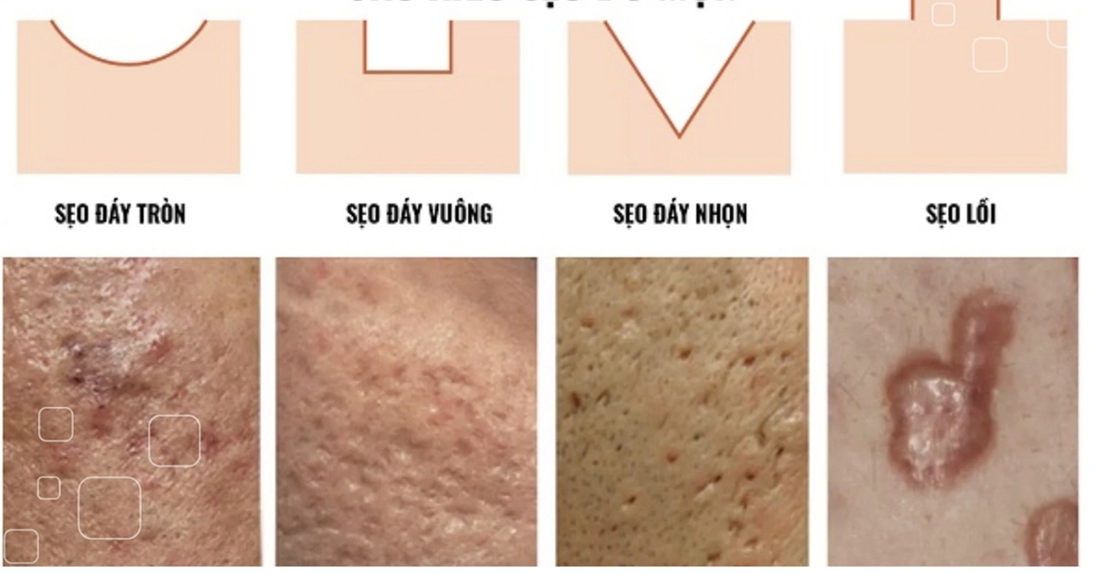 Scar Esthetique: Công nghệ trị sẹo tiên tiến chuẩn y khoa