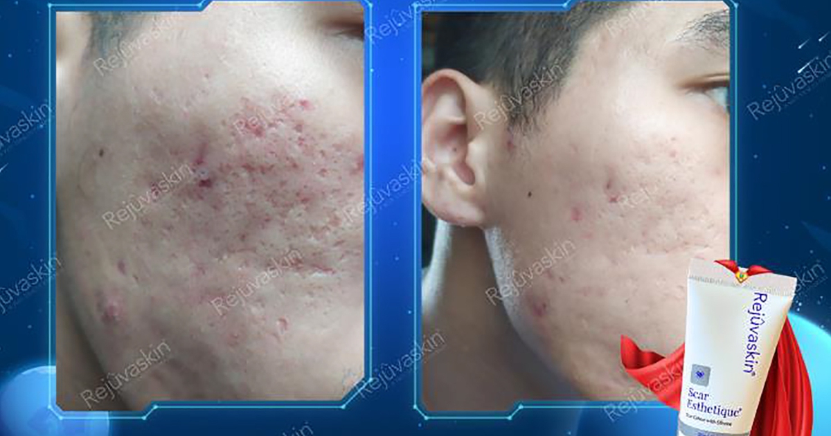 Scar Esthetique - Công thức phục hồi ‘cân tất’ mọi tổn thương sau mụn