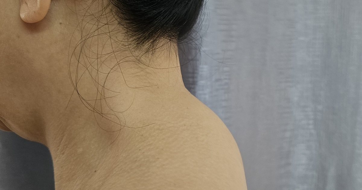 Thoái hóa, gai cột sống, khi nào cần phẫu thuật?