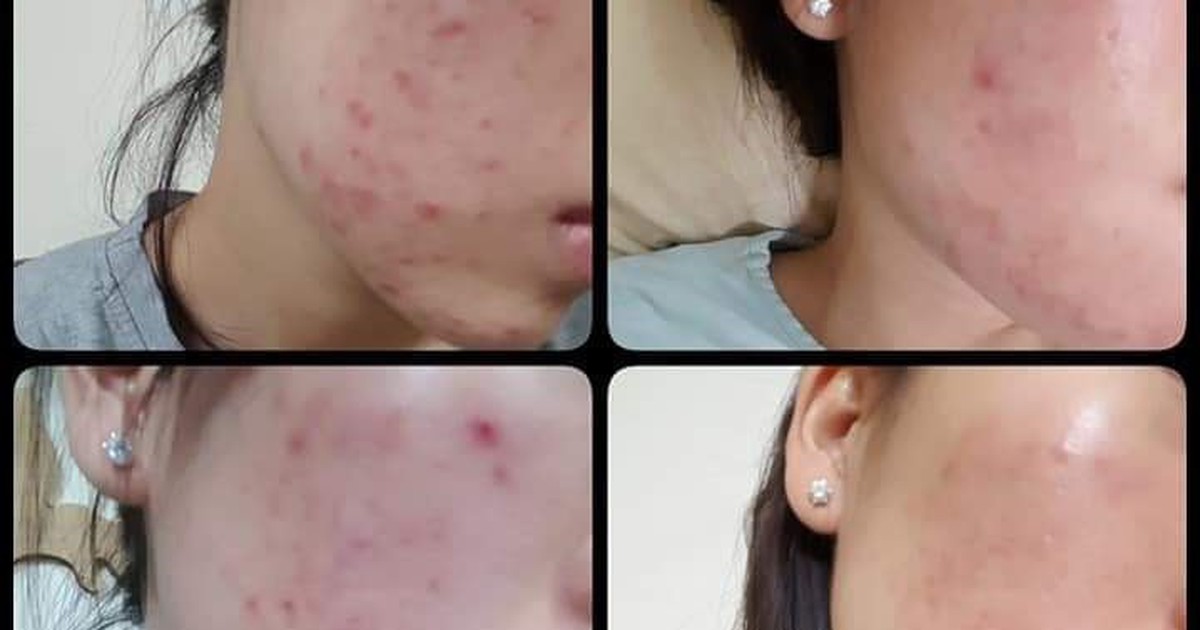 Top 12 kem trị mụn hiệu quả, không để lại thâm