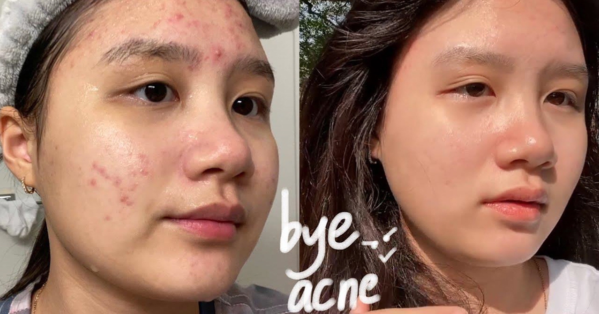 Top 12 kem trị mụn cho da dầu được gen Z, gen Alpha tìm mua nhiều