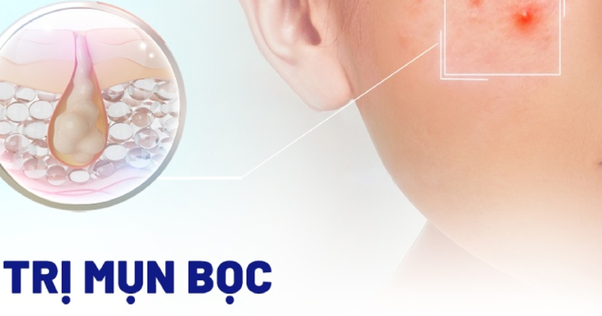 Top 10 kem trị mụn bọc 'cứu tinh' cho da dầu hết sưng, hết đau, không thâm