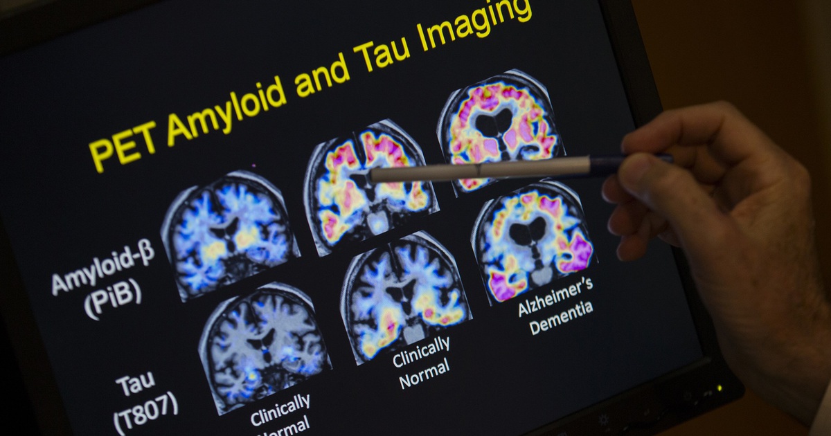 X&eacute;t nghiệm m&aacute;u đầu ti&ecirc;n cho bệnh Alzheimer được Mỹ ph&ecirc; duyệt