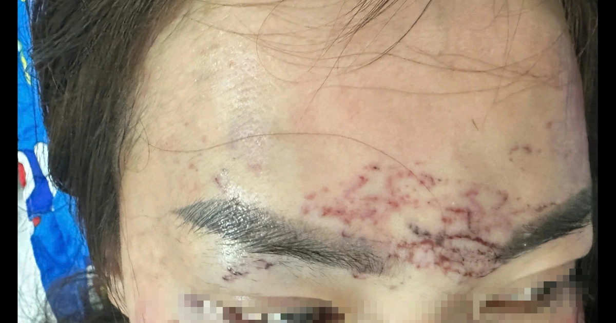 Khởi tố vụ án người phụ nữ bị bắt giữ, đánh đập, tạt axit vì ghen