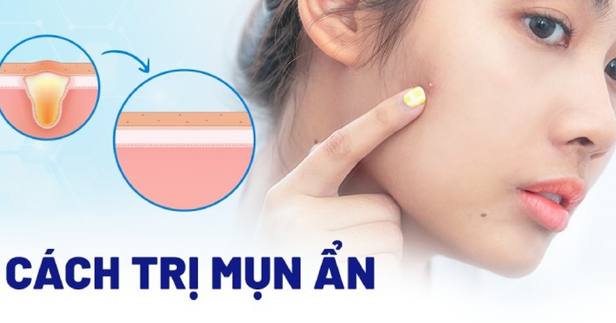 Bật mí cách trị mụn ẩn hiệu quả tại nhà, ngừa tái phát, không để lại sẹo