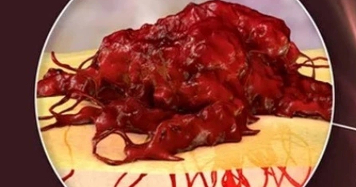 Mắc ung thư bị chẩn đoán sai, phải cắt một phần dương vật