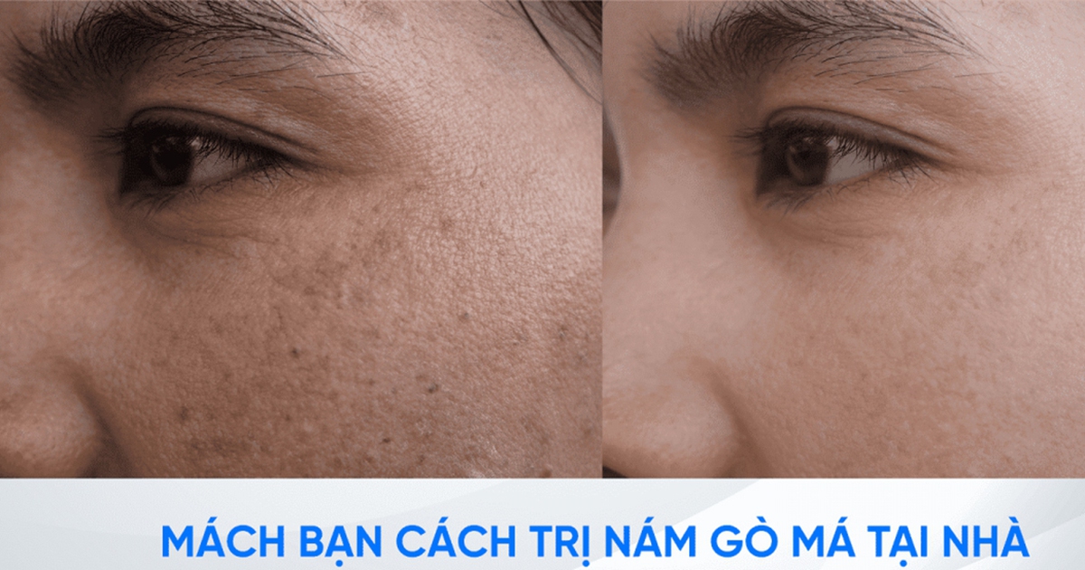 Làm thế nào để trị nám gò má dứt điểm ngay tại nhà, không xâm lấn?
