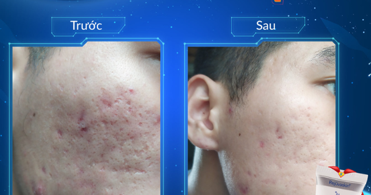 Kiến trúc làn da: ‘vật liệu’ nào giúp tái xây nền da, lấp đầy sẹo lõm?