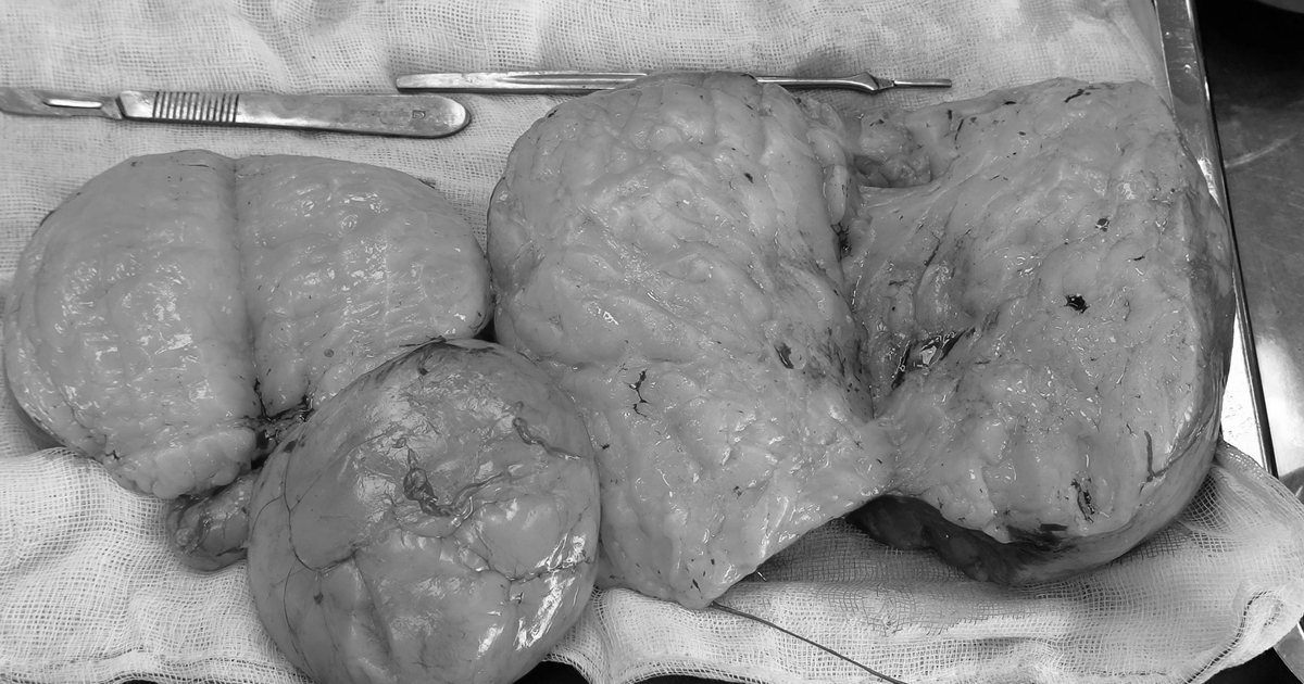 3 khối bướu mỡ nặng 1,5 kg được lấy ra khỏi cơ thể người phụ nữ