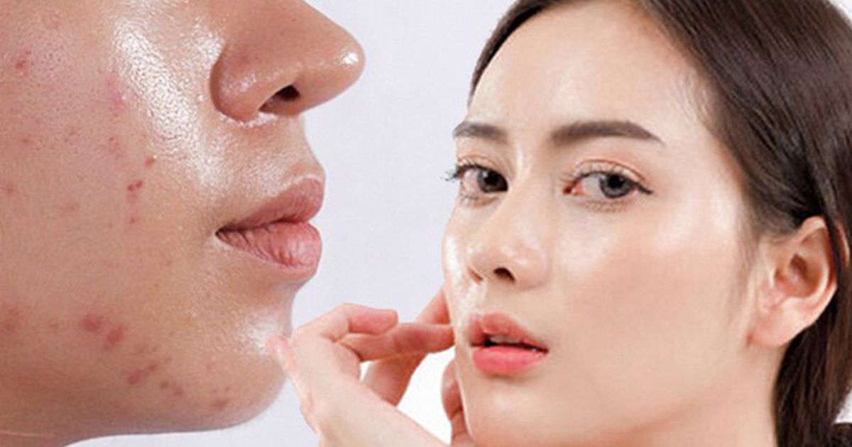 Top 7 kem chống nắng cho da dầu mụn khô thoáng, không bóng nhờn, không gây mụn