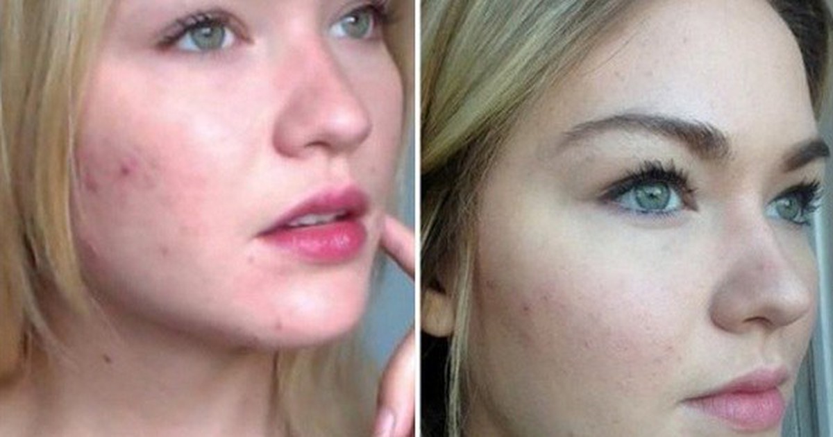 Gợi ý cách trị mụn bọc chuẩn y khoa hiệu quả tại nhà, ngăn ngừa sẹo xấu