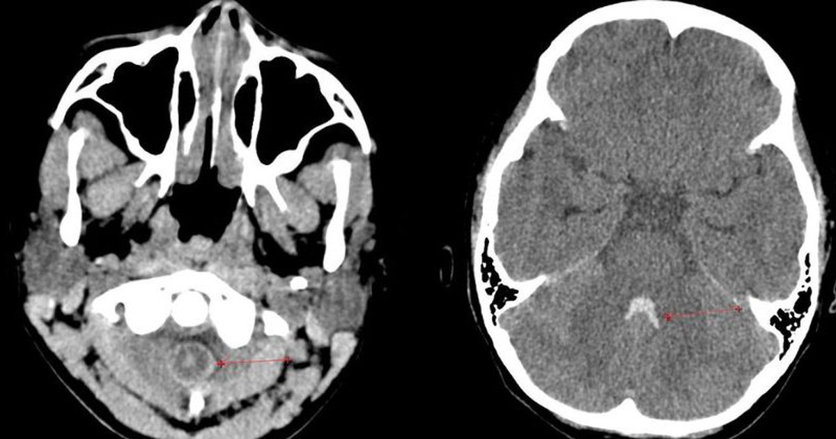 Cấp cứu cô gái 32 tuổi nghi bị xuất huyết não tự phát ở người trẻ