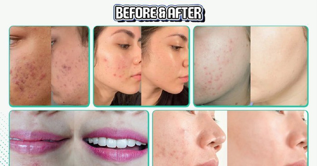 Trị mụn cấp tốc có thực sự an toàn? Lợi ích và tác hại bạn cần biết
