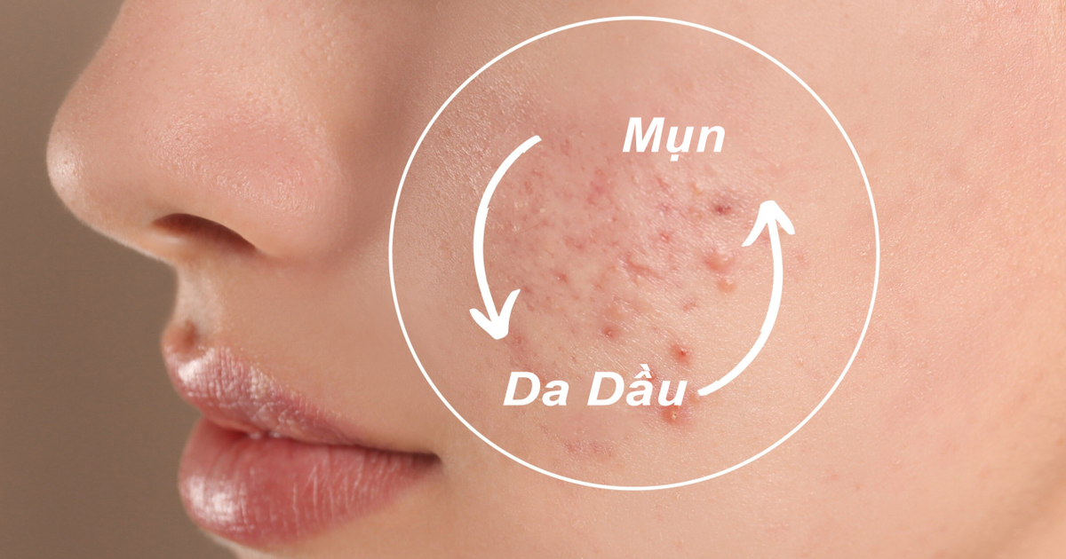 Top 7 sữa rửa mặt cho da dầu mụn sạch mịn, dịu nhẹ đang được mua nhiều