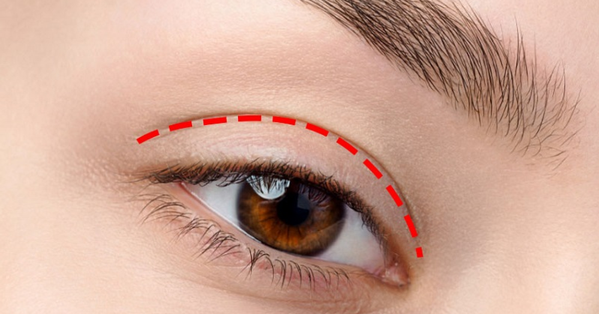 Vết thâm tiểu phẫu không chịu hết? Đây là mẹo chăm chuyên gia hay dùng!