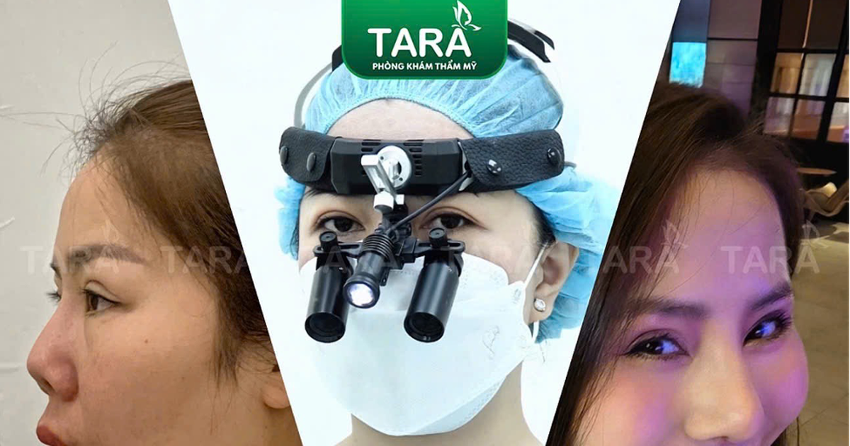 Sửa lại mũi hỏng nhanh lành với ứng dụng nâng mũi siêu vi phẫu