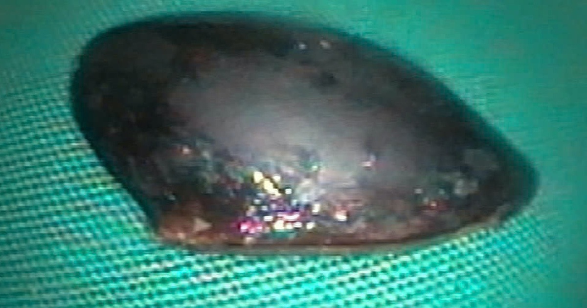 Ho dai dẳng, tưởng bệnh nặng, không ngờ thủ phạm là hạt trái cây