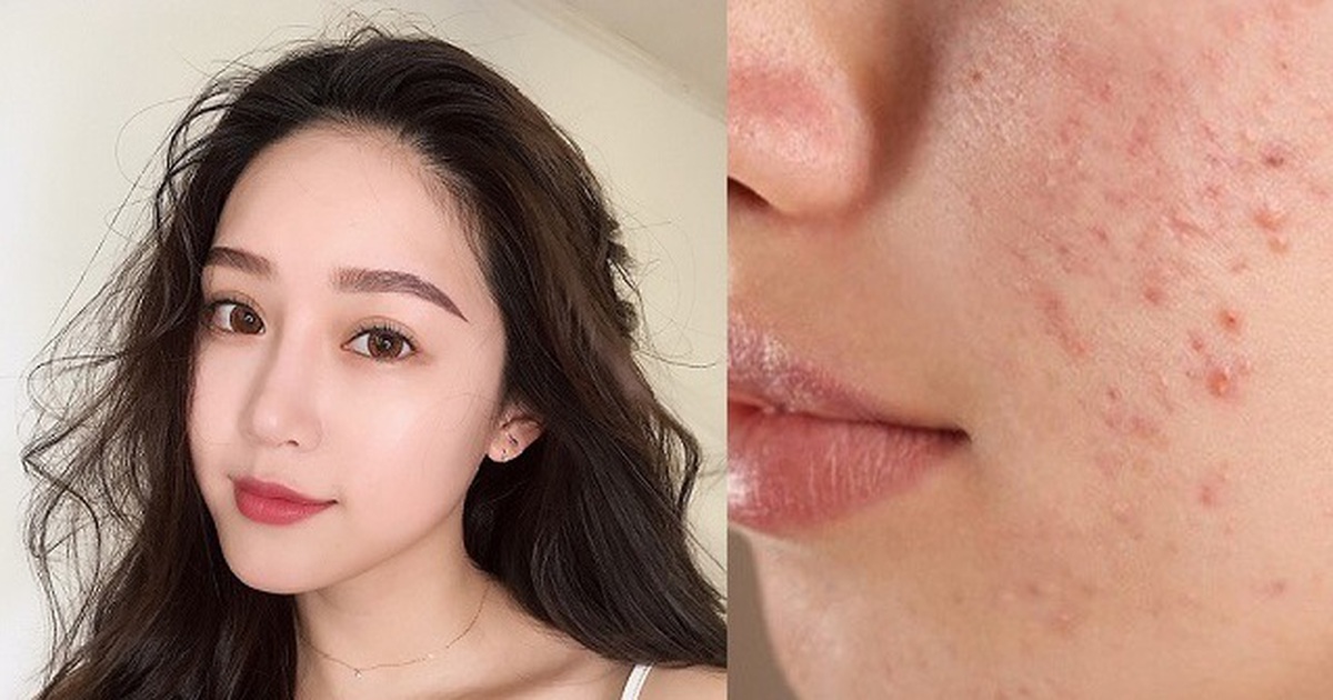 Top 10 kem chống nắng cho da mụn thông thoáng, không bóng nhờn, ngừa mụn hiệu quả
