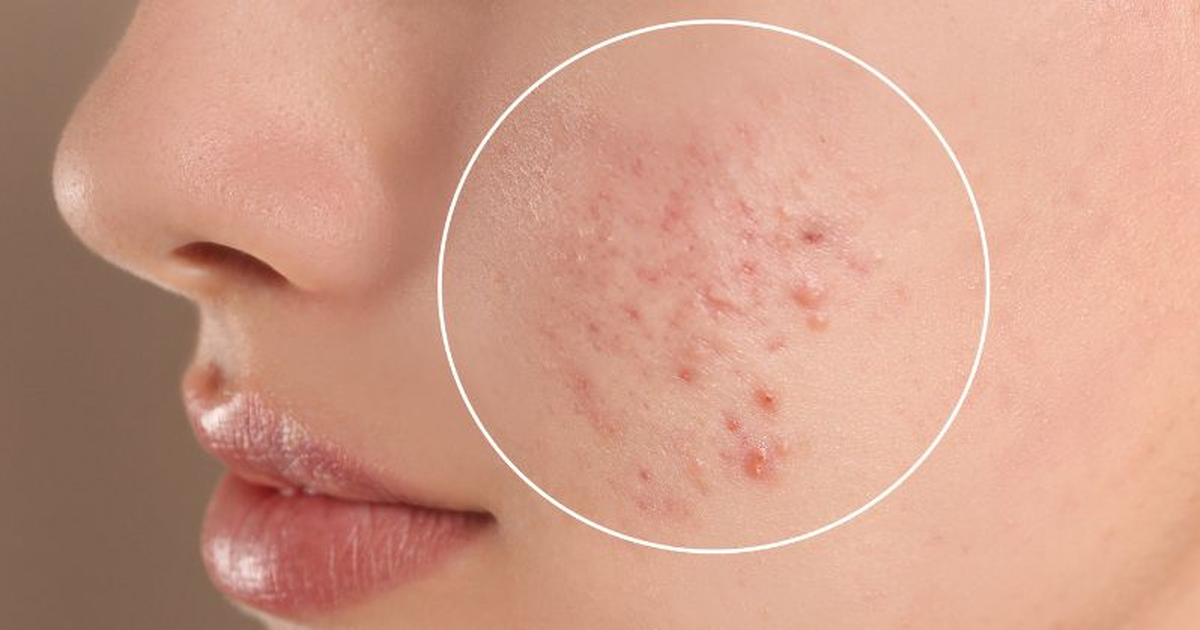 Vì sao da dễ nổi mụn vào giao mùa?