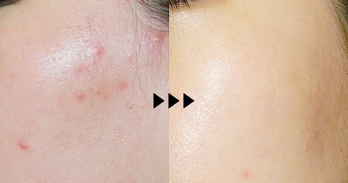 Top 5 kem giảm mụn viêm sưng xẹp nhanh, ngăn tái phát và ngừa sẹo hiệu quả