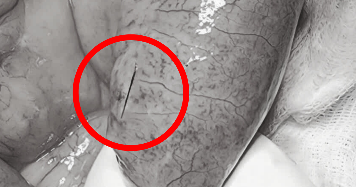 Cụ ông bị mảnh xương cá dài 4 cm cứa thủng ruột