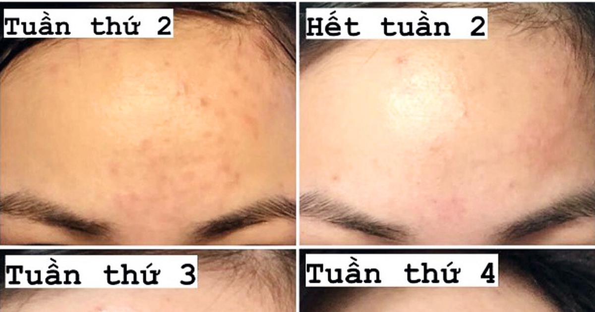 [Review] Top 4 kem giảm mụn ẩn hiệu quả, ngừa sẹo tối đa cho da láng mịn