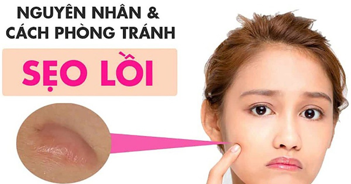 Sẹo lồi: Nguyên nhân và cách điều trị với cả sẹo lâu năm, ngừa tái phát