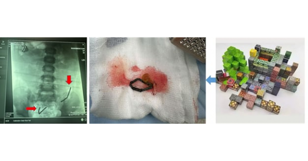 TP.HCM: Nuốt 20 viên nam châm, ruột non bé trai bị thủng 8 lỗ