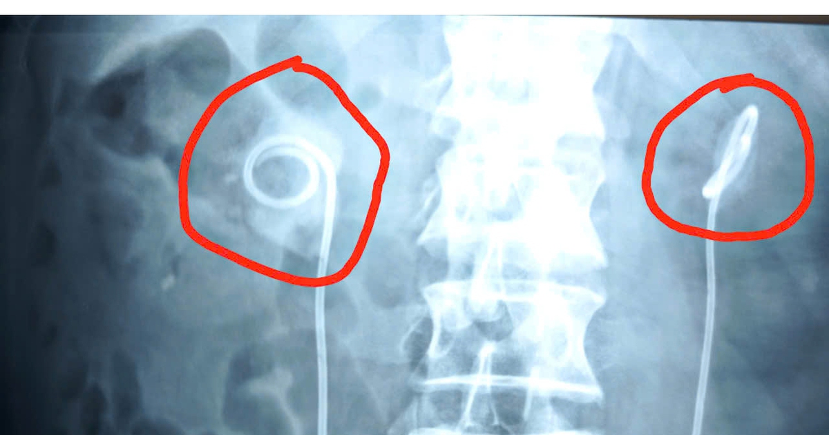 Sỏi bám đầy ống thông JJ sau 2 năm quên trong niệu quản