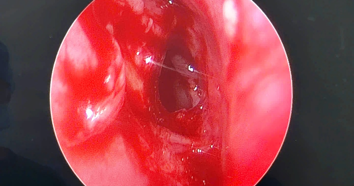 Hiếm gặp: Cụ ông mất hoàn toàn thị lực mắt trái vì khối u nhầy xoang bướm