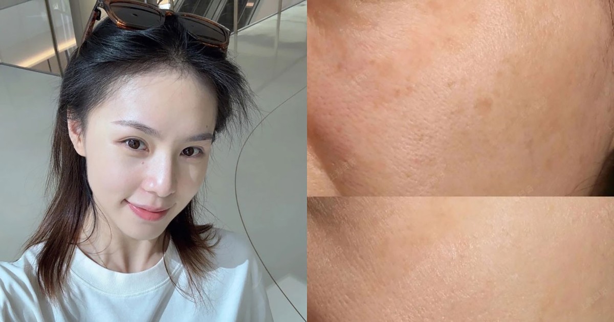 Top 3 serum tranexamic acid giúp mờ nám sạm sau 4 tuần dù chân sâu, lâu năm