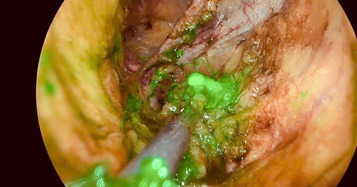 Lần đầu tiên Việt Nam ứng dụng kỹ thuật mới điều trị ung thư phụ khoa