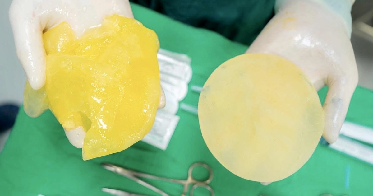 Túi nâng ngực có dễ vỡ khi chơi thể thao?