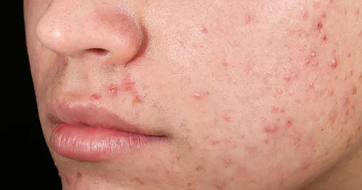 Da sau mụn nhạy cảm kéo dài: Khi hàng rào da chưa thực sự hồi phục