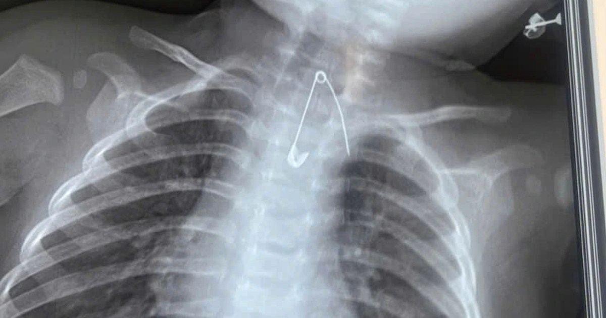 2 trẻ nguy kịch vì nuốt dị vật