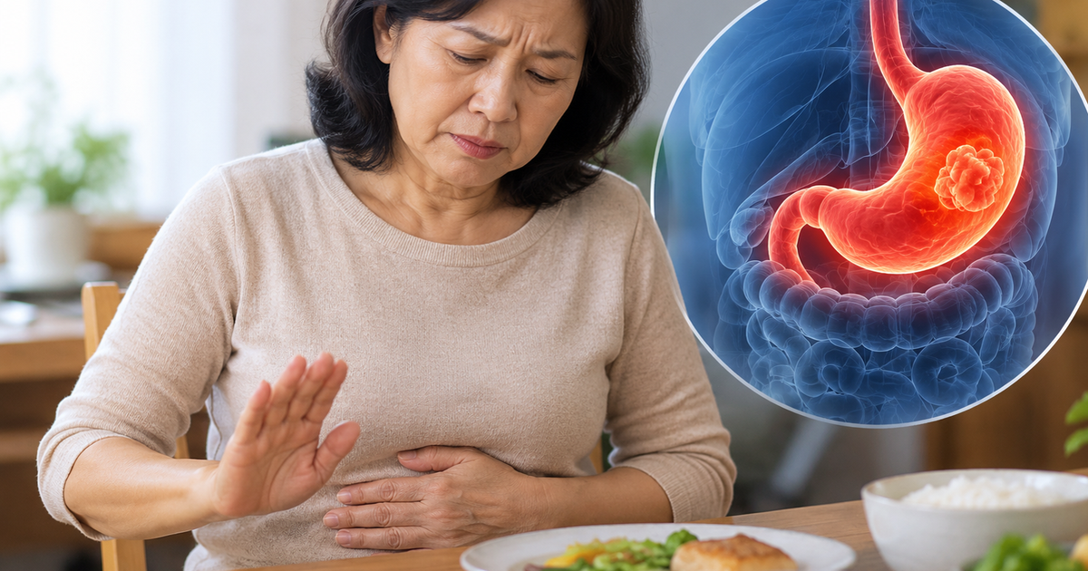 4 dấu hiệu ung thư dạ dày dễ bị nhầm với rối loạn tiêu hóa