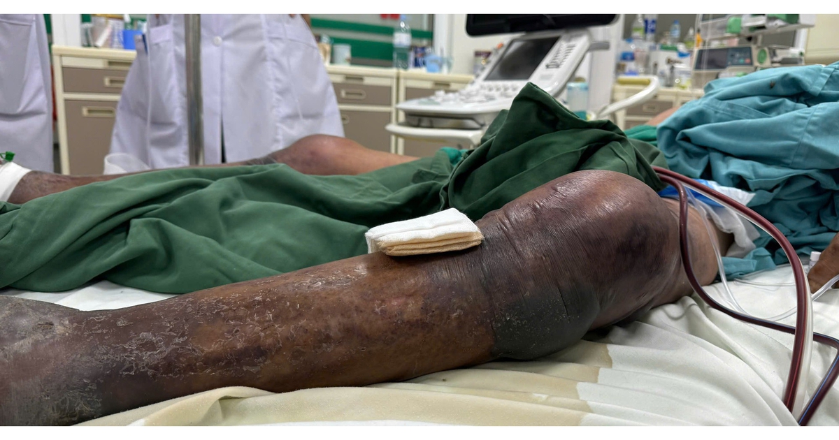 Sốc nhiễm khuẩn, suy đa tạng sau khi ăn tiết canh