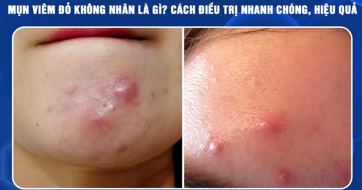 Mụn sưng đỏ không nhân: Càng muốn nặn càng dễ thâm, chấm mụn thế nào mới đúng?