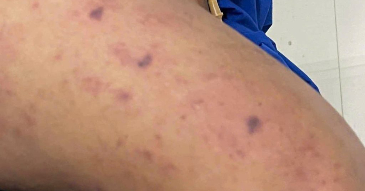 TP.HCM thông tin về học sinh mắc bệnh do não mô cầu, 99 người tiếp xúc