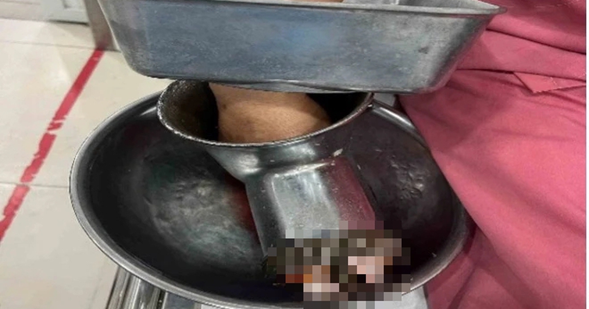 Bị máy xay thịt "nuốt" bàn tay, người phụ nữ ở TP.HCM phải cắt cụt 3 ngón