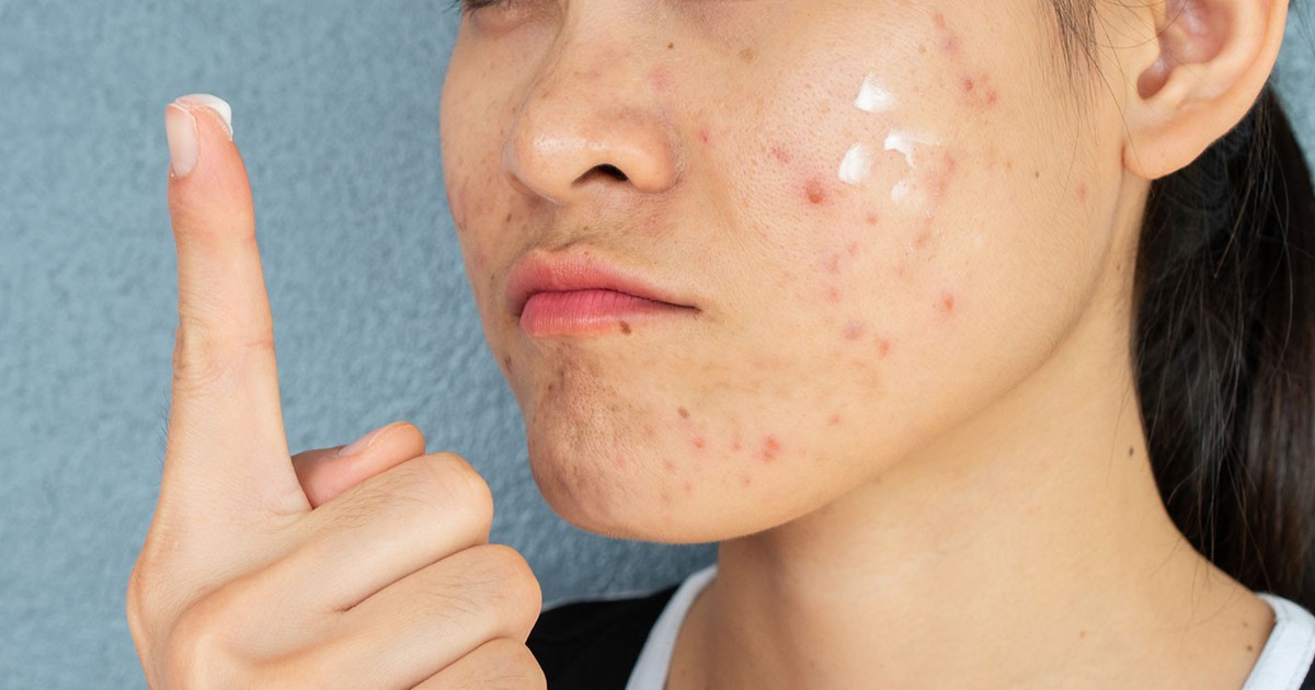 Da vùng má dễ bị thâm mụn? Cách chăm sóc da giúp da đều màu hơn