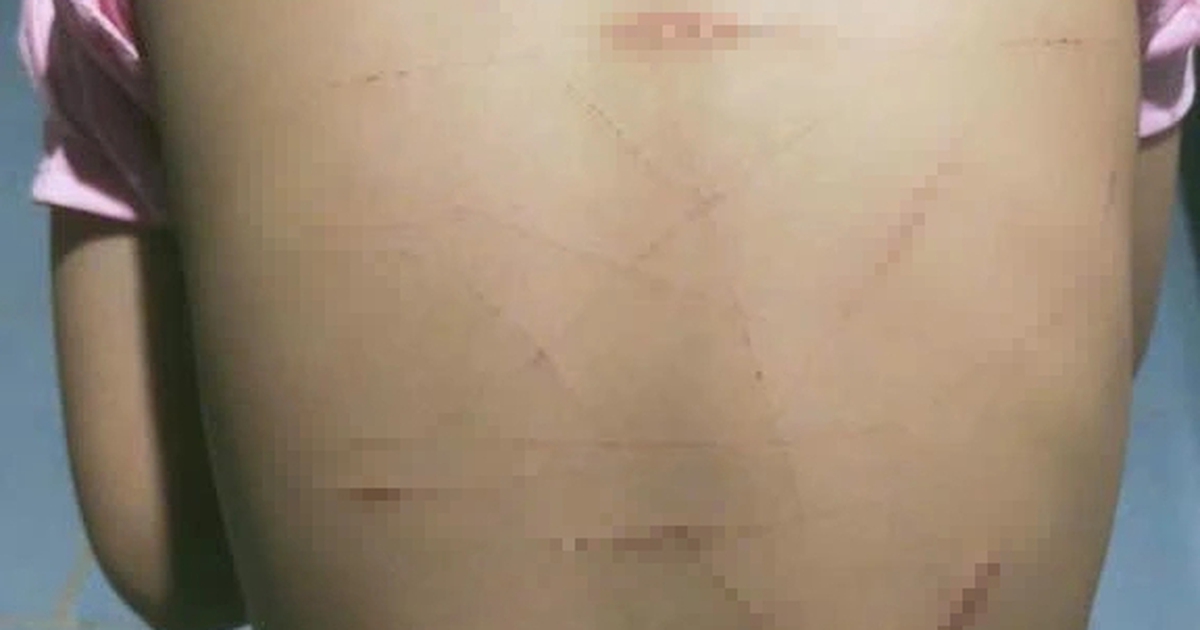 Vụ học sinh lớp 5 ở Cà Mau nghi bị bạo hành: Chưa đủ tuổi xử lý