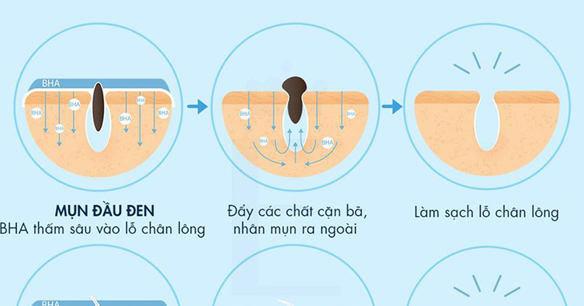 Da mụn nên dùng BHA hay AHA - phương pháp chăm da mụn chuẩn khoa học