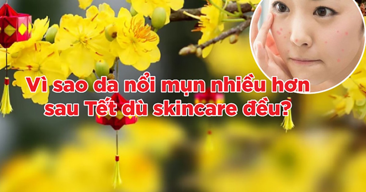 Vì sao da dễ nổi mụn sau Tết dù skincare rất kỹ?