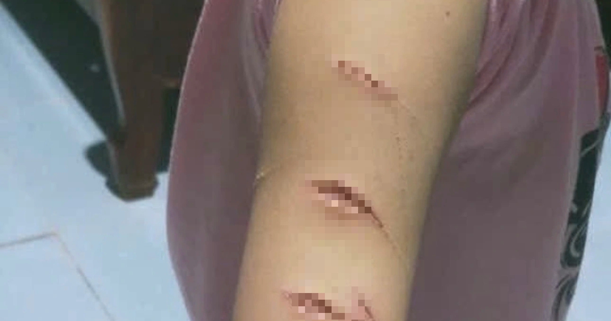 Cà Mau: Học sinh lớp 5 đến lớp với nhiều vết thương, nghi bị bạo hành