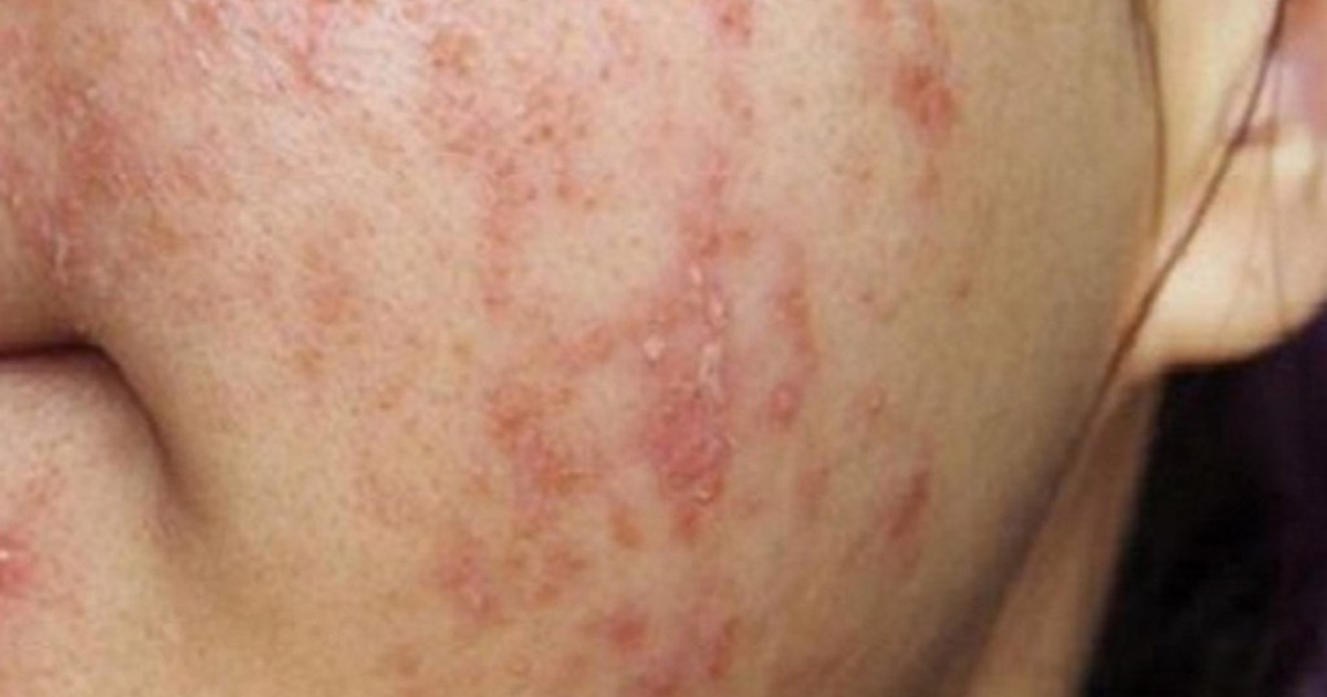 Bác sĩ cảnh báo về trào lưu 'đào thải corticoid' trên mạng