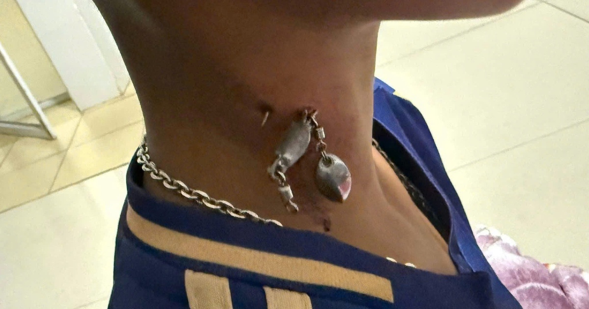 M&oacute;c c&acirc;u mắc s&acirc;u v&agrave;o cổ bệnh nhi 13 tuổi ở Quảng Trị