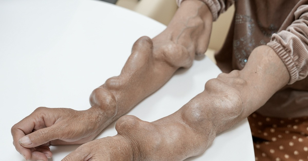 Điều trị ca bệnh thận nhân tạo biến dạng tay do giãn tĩnh mạch